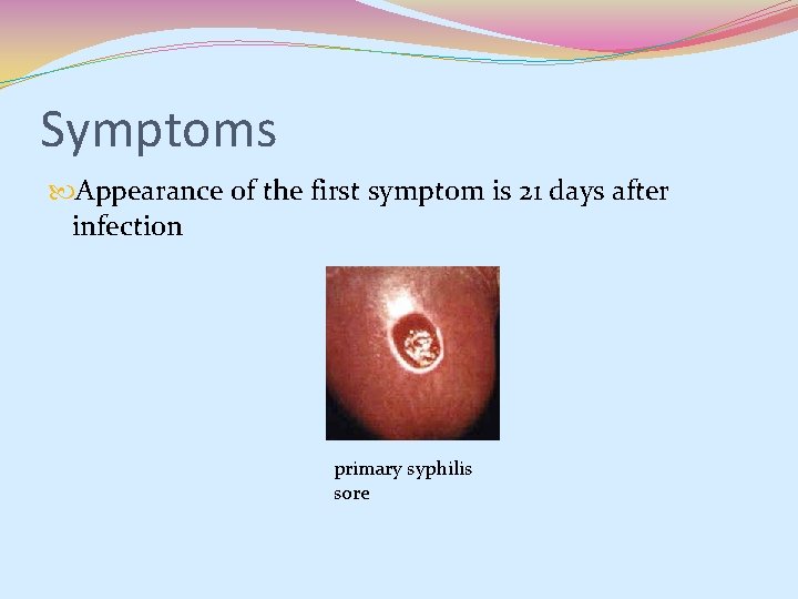 Symptoms Appearance of the first symptom is 21 days after infection primary syphilis sore Symptoms Appearance of the first symptom is 21 days after infection primary syphilis sore