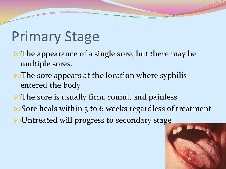 Primary Stage The appearance of a single sore, but there may be multiple sores. Primary Stage The appearance of a single sore, but there may be multiple sores.