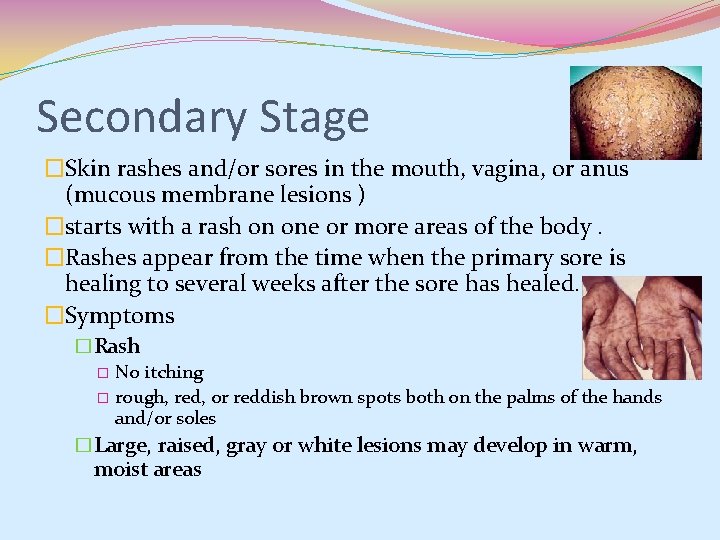 Secondary Stage �Skin rashes and/or sores in the mouth, vagina, or anus (mucous membrane Secondary Stage �Skin rashes and/or sores in the mouth, vagina, or anus (mucous membrane