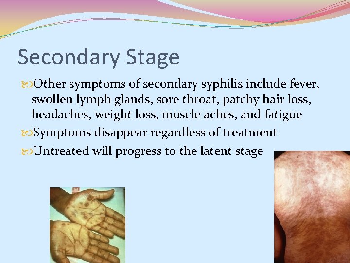 Secondary Stage Other symptoms of secondary syphilis include fever, swollen lymph glands, sore throat, Secondary Stage Other symptoms of secondary syphilis include fever, swollen lymph glands, sore throat,