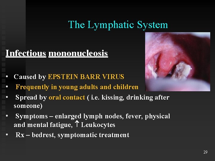 The Lymphatic System Infectious mononucleosis • • • Caused by EPSTEIN BARR VIRUS Frequently