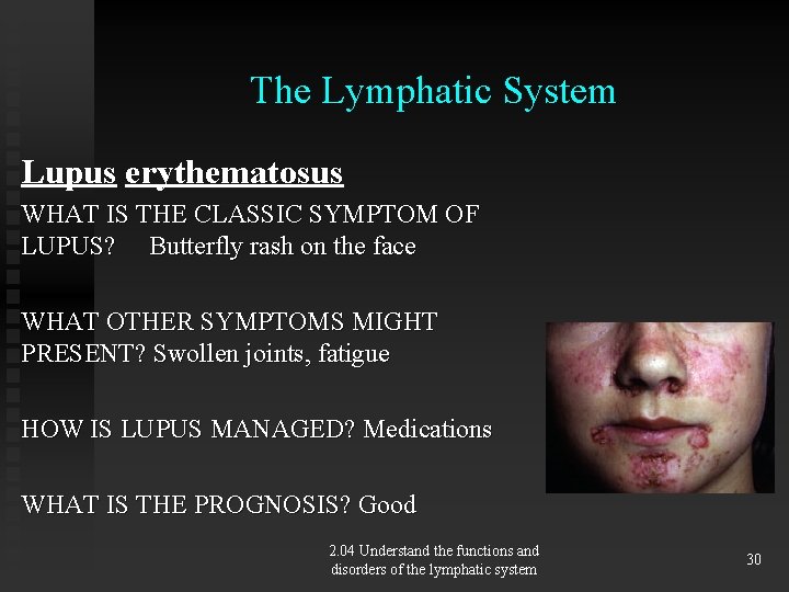 The Lymphatic System Lupus erythematosus WHAT IS THE CLASSIC SYMPTOM OF LUPUS? Butterfly rash