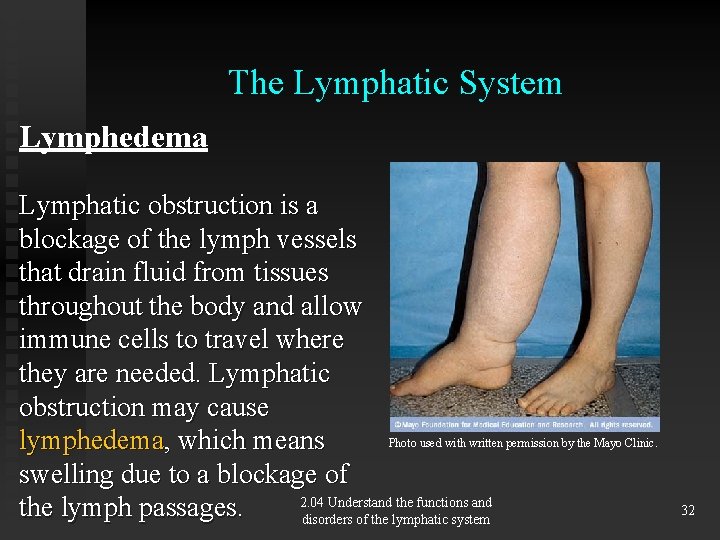 The Lymphatic System Lymphedema Lymphatic obstruction is a blockage of the lymph vessels that