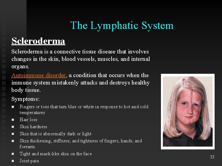 The Lymphatic System Scleroderma is a connective tissue disease that involves changes in the