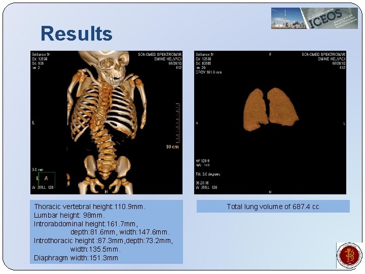 Results Thoracic vertebral height: 110. 9 mm. Lumbar height: 98 mm. Introrabdominal height: 161.