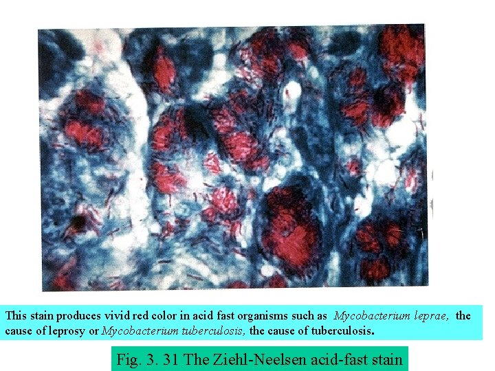 This stain produces vivid red color in acid fast organisms such as Mycobacterium leprae,