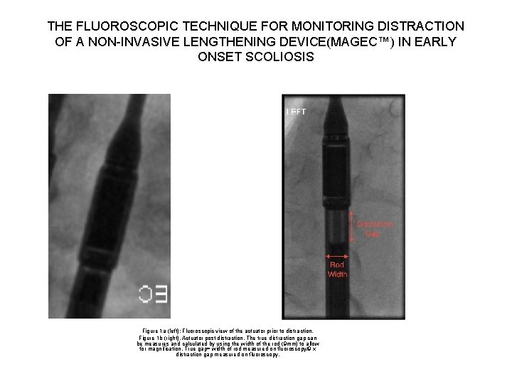 THE FLUOROSCOPIC TECHNIQUE FOR MONITORING DISTRACTION OF A NON-INVASIVE LENGTHENING DEVICE(MAGEC™) IN EARLY ONSET THE FLUOROSCOPIC TECHNIQUE FOR MONITORING DISTRACTION OF A NON-INVASIVE LENGTHENING DEVICE(MAGEC™) IN EARLY ONSET