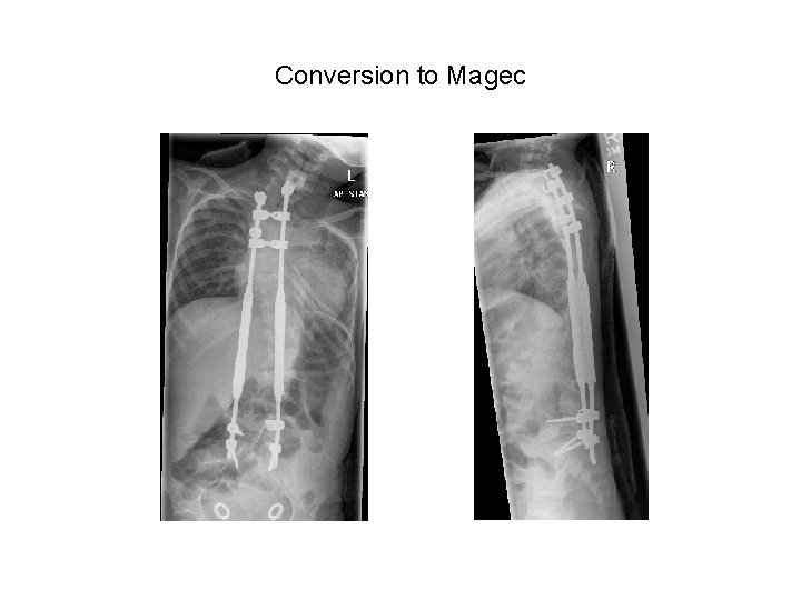 Conversion to Magec Conversion to Magec