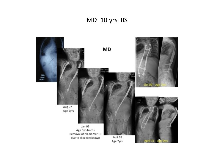 MD 10 yrs IIS MD 10 yrs IIS