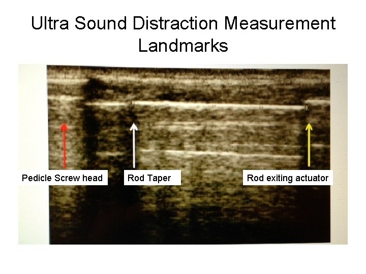 Ultra Sound Distraction Measurement Landmarks Pedicle Screw head Rod Taper Rod exiting actuator Ultra Sound Distraction Measurement Landmarks Pedicle Screw head Rod Taper Rod exiting actuator