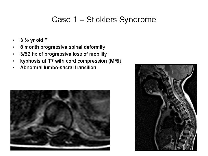 Case 1 – Sticklers Syndrome • • • 3 ½ yr old F 8 Case 1 – Sticklers Syndrome • • • 3 ½ yr old F 8