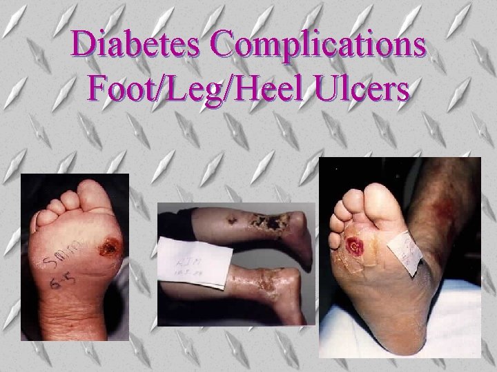 Diabetes Complications Foot/Leg/Heel Ulcers Diabetes Complications Foot/Leg/Heel Ulcers