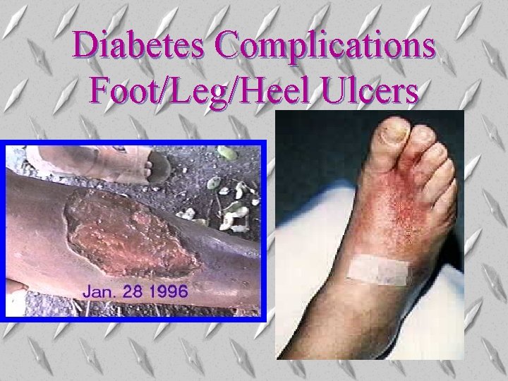 Diabetes Complications Foot/Leg/Heel Ulcers Diabetes Complications Foot/Leg/Heel Ulcers