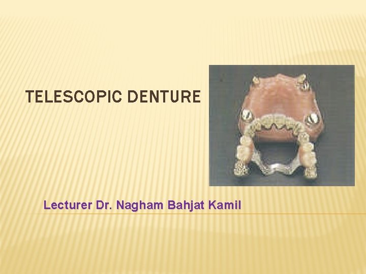 TELESCOPIC DENTURE Lecturer Dr. Nagham Bahjat Kamil 