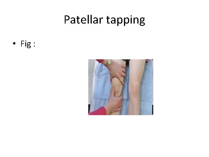 Patellar tapping • Fig : 