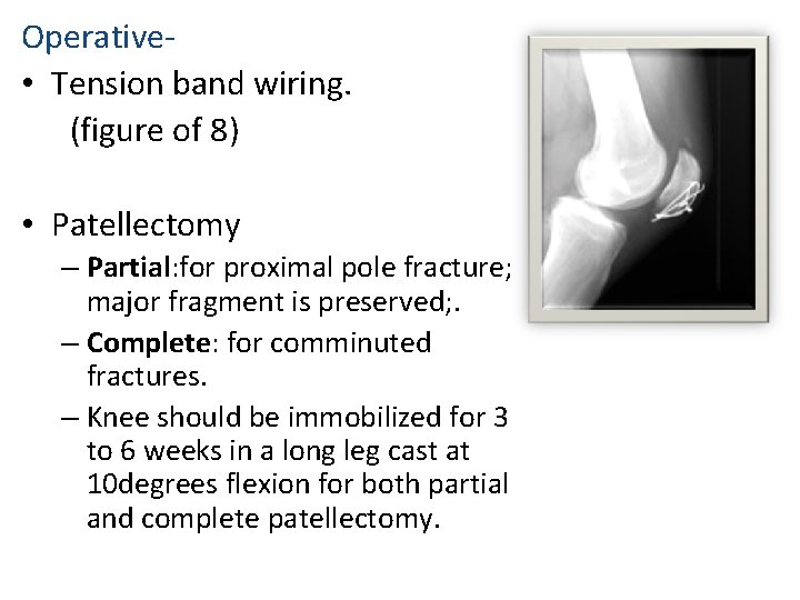 Operative • Tension band wiring. (figure of 8) • Patellectomy – Partial: for proximal