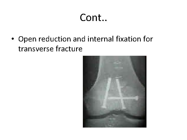 Cont. . • Open reduction and internal fixation for transverse fracture 