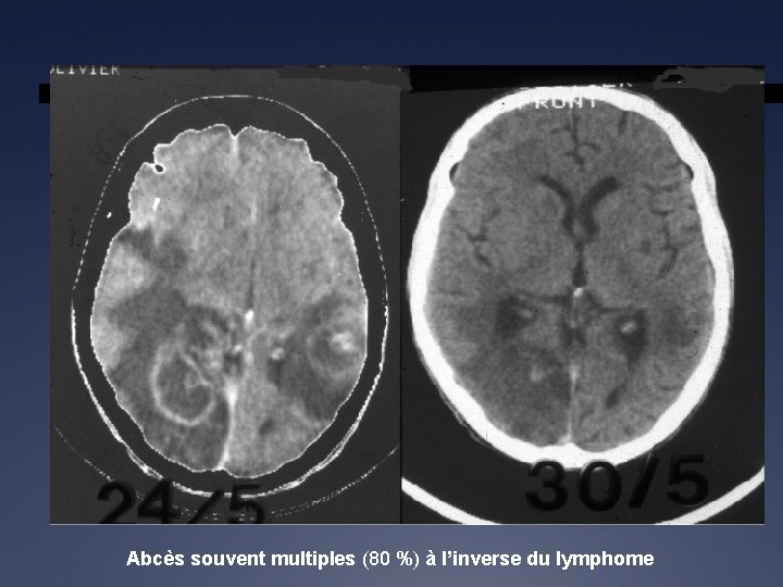 Abcès souvent multiples (80 %) à l’inverse du lymphome 