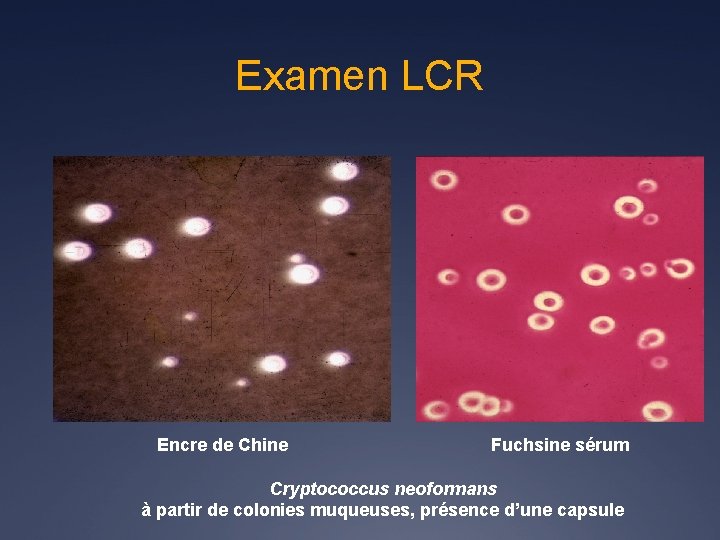 Examen LCR Encre de Chine Fuchsine sérum Cryptococcus neoformans à partir de colonies muqueuses,