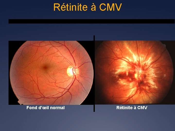 Rétinite à CMV Fond d’œil normal Rétinite à CMV 