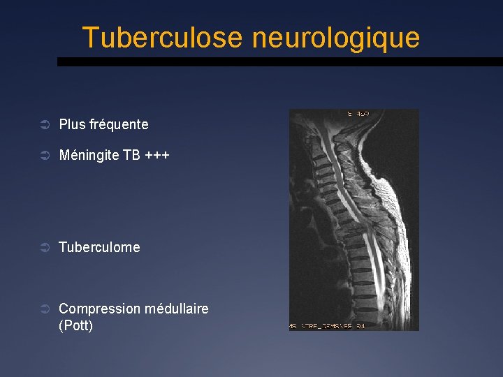 Tuberculose neurologique Ü Plus fréquente Ü Méningite TB +++ Ü Tuberculome Ü Compression médullaire