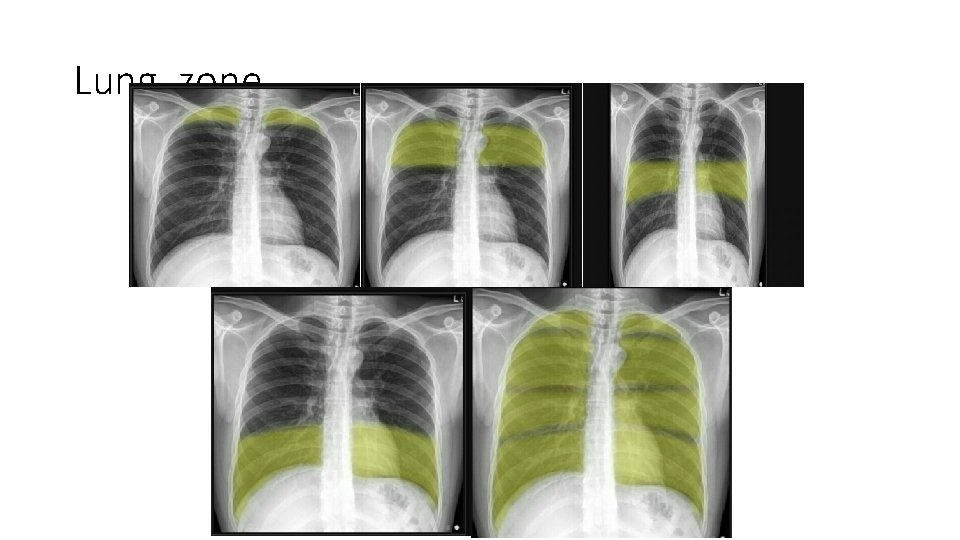 Lung zone 