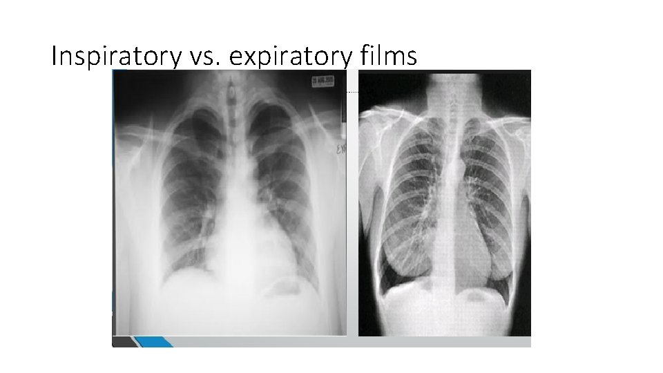 Inspiratory vs. expiratory films 