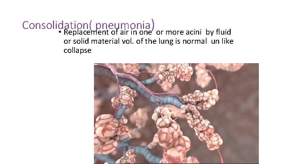 Consolidation( pneumonia ) • Replacement of air in one or more acini by fluid