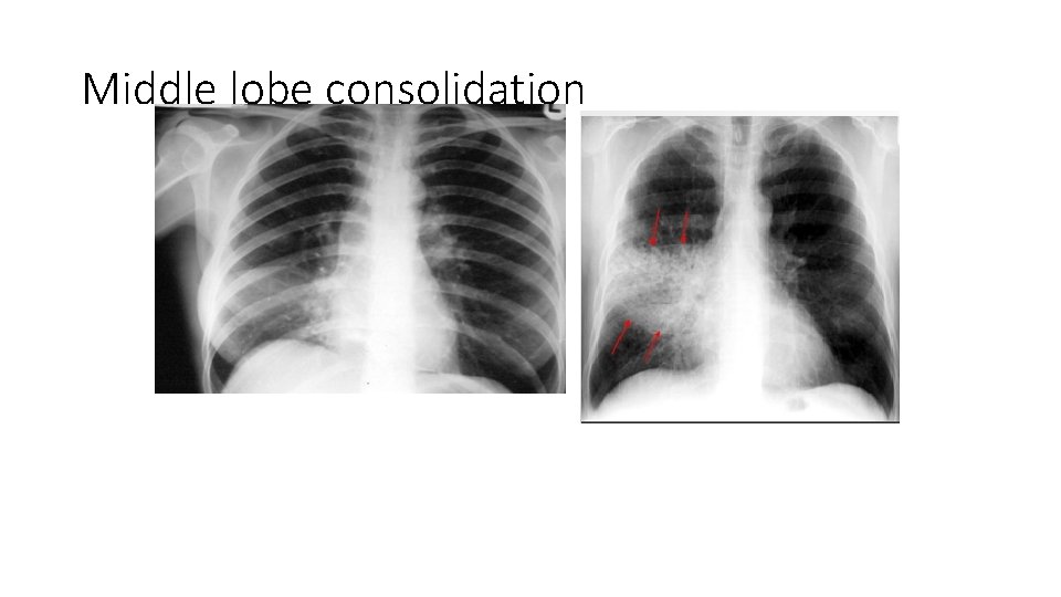 Middle lobe consolidation 