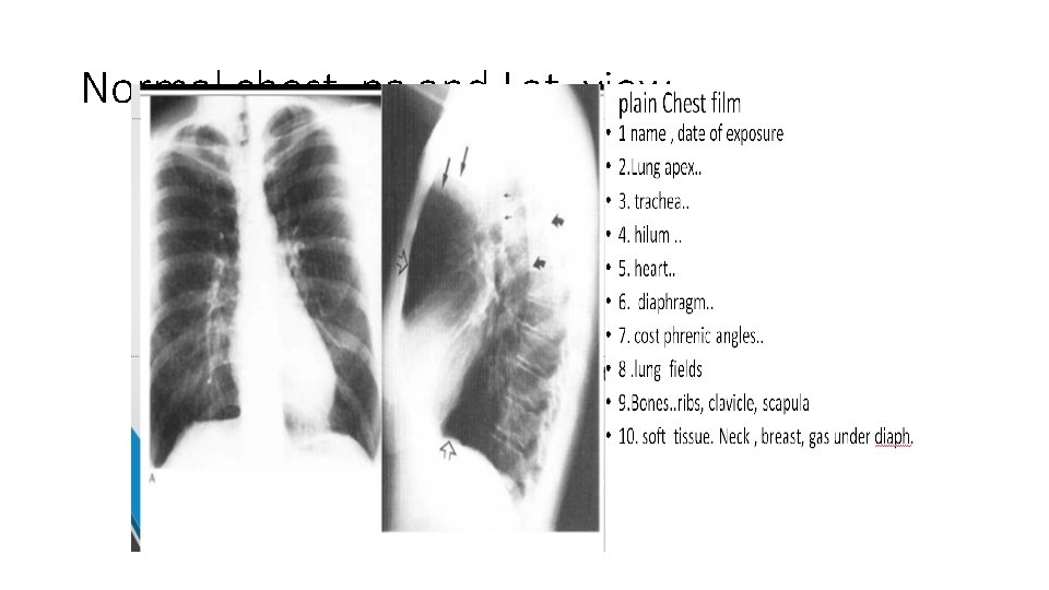 Normal chest pa and Lat. view 