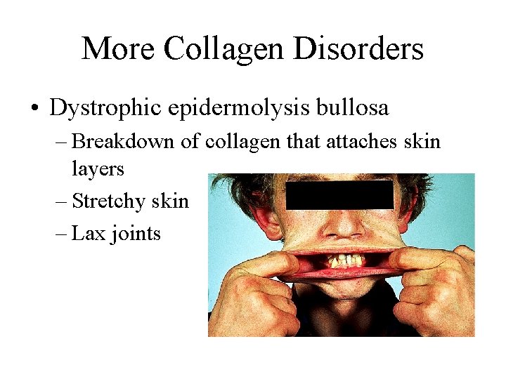More Collagen Disorders • Dystrophic epidermolysis bullosa – Breakdown of collagen that attaches skin