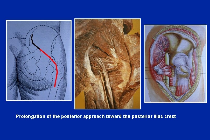 Prolongation of the posterior approach toward the posterior iliac crest 