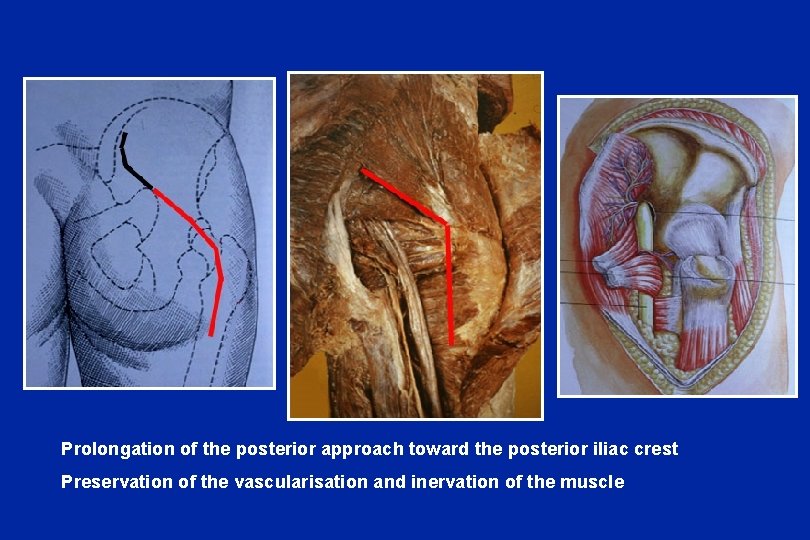 Prolongation of the posterior approach toward the posterior iliac crest Preservation of the vascularisation