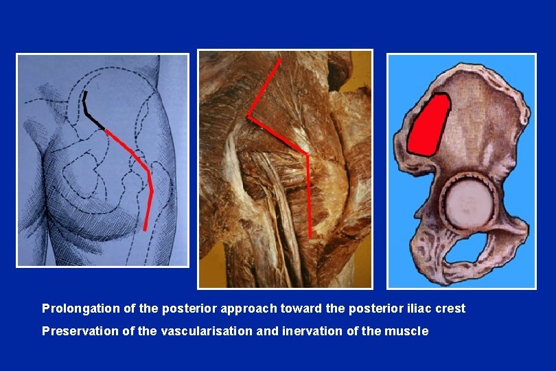 Prolongation of the posterior approach toward the posterior iliac crest Preservation of the vascularisation