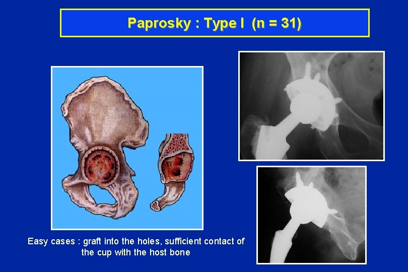 Paprosky : Type I (n = 31) Easy cases : graft into the holes,