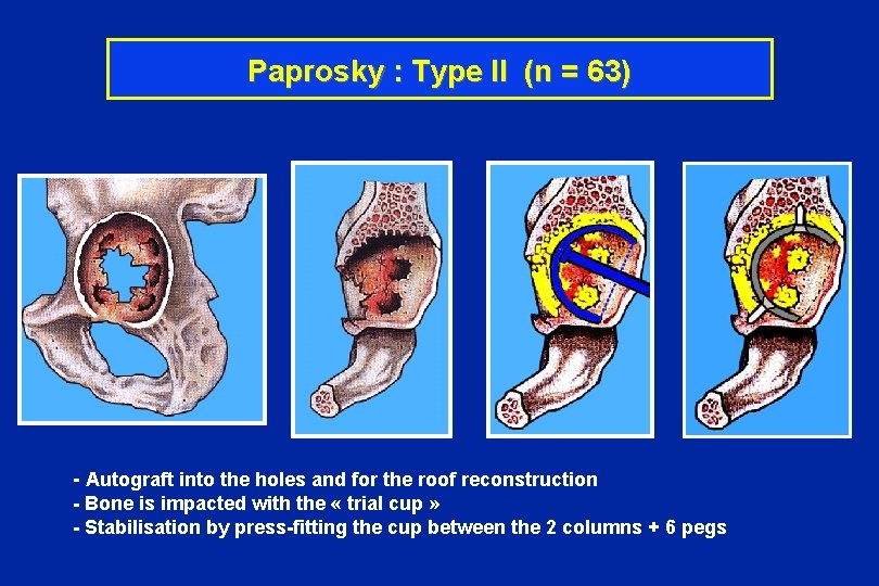 Paprosky : Type II (n = 63) - Autograft into the holes and for