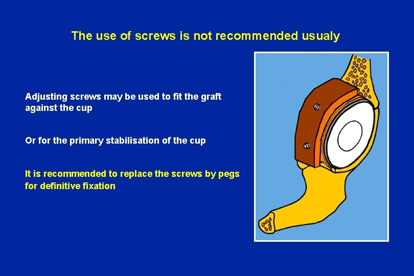 The use of screws is not recommended usualy Adjusting screws may be used to