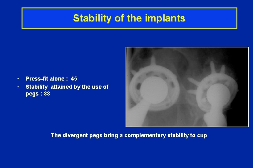 Stability of the implants • • Press-fit alone : 45 Stability attained by the