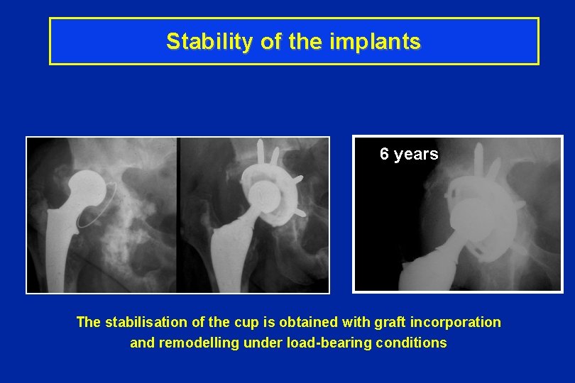 Stability of the implants 6 years The stabilisation of the cup is obtained with