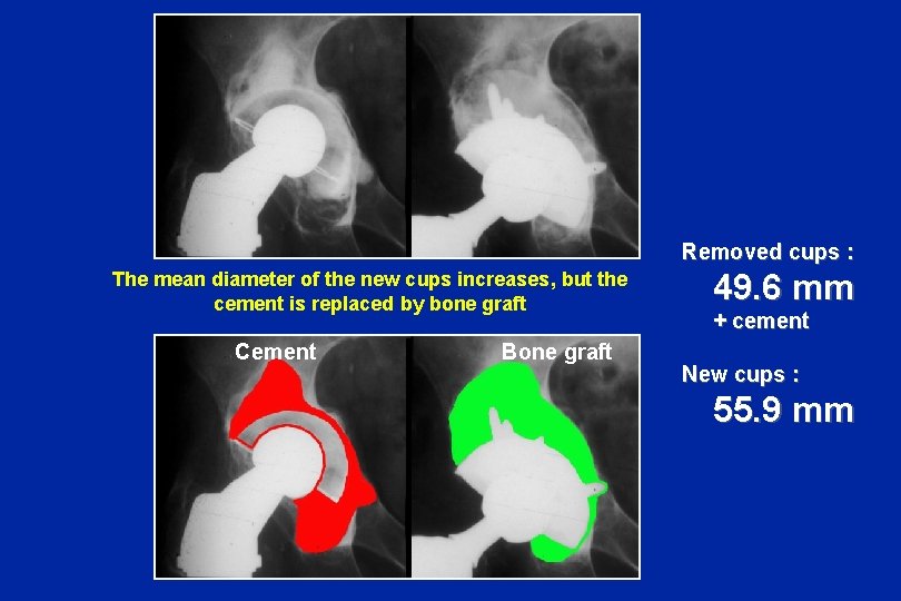 Removed cups : The mean diameter of the new cups increases, but the cement