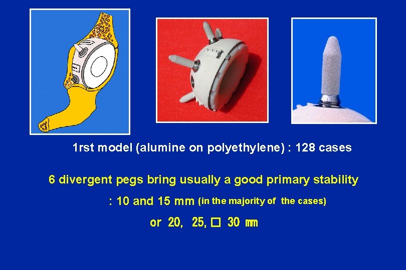 1 rst model (alumine on polyethylene) : 128 cases 6 divergent pegs bring usually