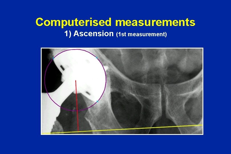 Computerised measurements 1) Ascension (1 st measurement) 