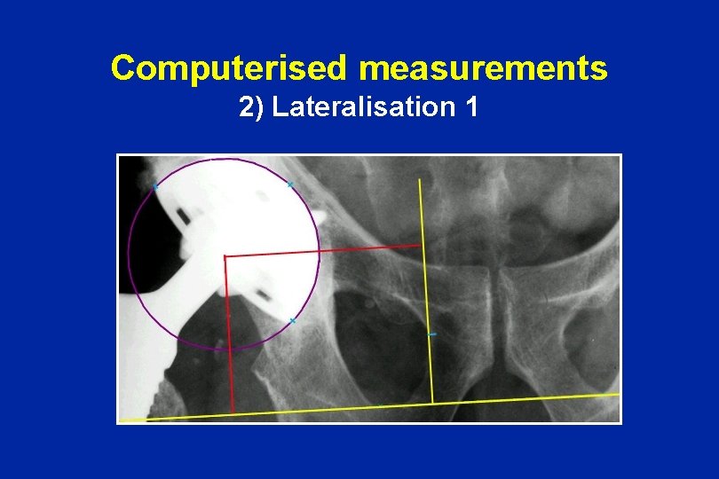 Computerised measurements 2) Lateralisation 1 
