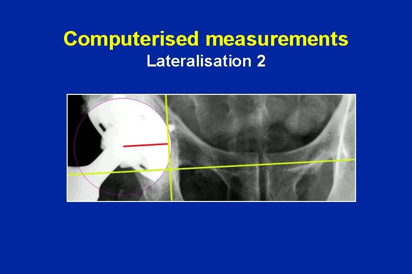 Computerised measurements Lateralisation 2 