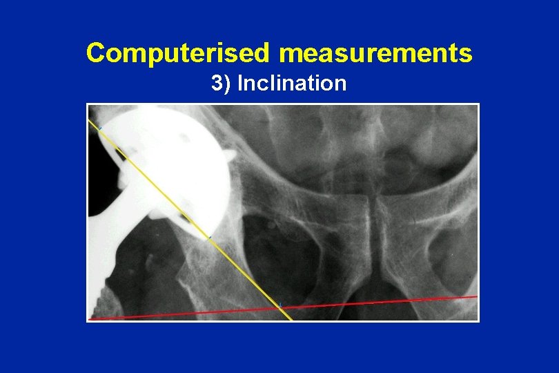 Computerised measurements 3) Inclination 