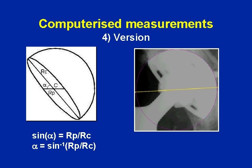 Computerised measurements 4) Version sin(a) = Rp/Rc a = sin-1(Rp/Rc) 