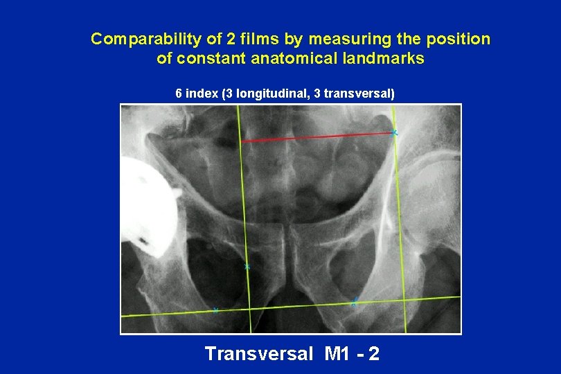 Comparability of 2 films by measuring the position of constant anatomical landmarks 6 index