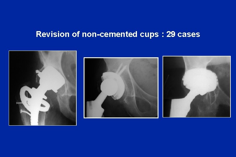 Revision of non-cemented cups : 29 cases 