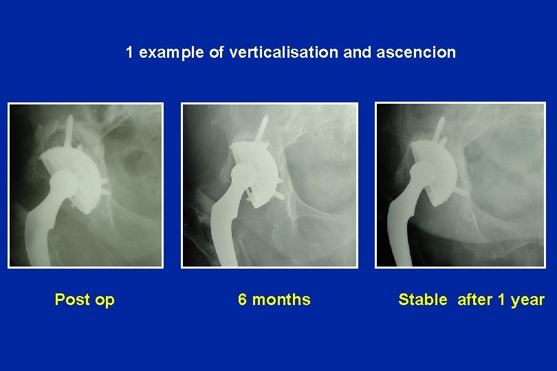 1 example of verticalisation and ascencion Post op 6 months Stable after 1 year