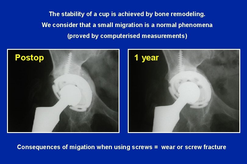 The stability of a cup is achieved by bone remodeling. We consider that a